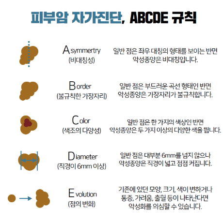 피부암점 ABCDE 구분