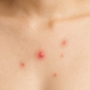 가슴 여드름 관리