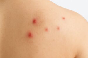 등 여드름 관리