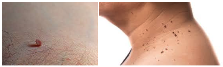 쥐젖 당뇨 환자 부위